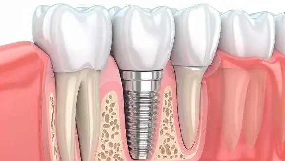 What to Expect After Dental Implant Surgery: Day-by-Day Healing Guide
