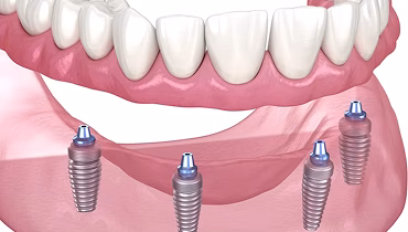 Full Mouth Dental Implants vs. All-on-4: Which is Right for You?