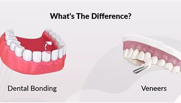 Porcelain Veneers vs. Composite Bonding — What’s Right for You?