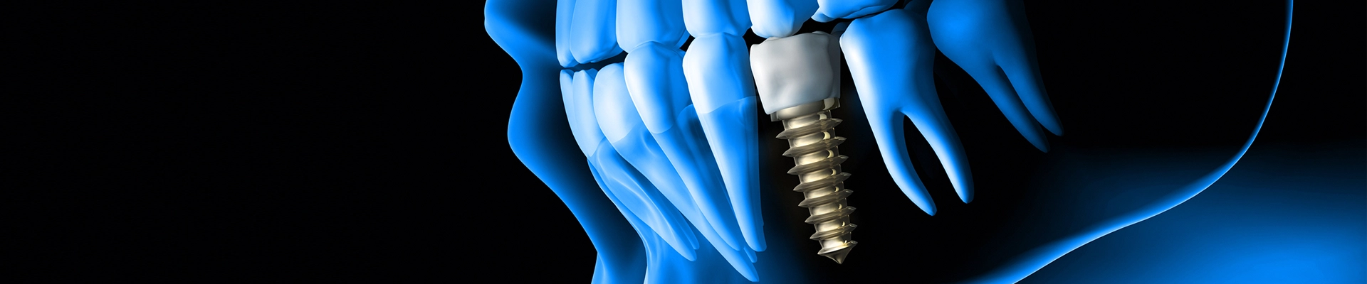 dental-implant