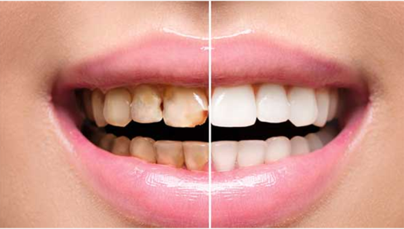 Full Mouth Rehabilitation: How to Rebuild a Smile from Scratch
