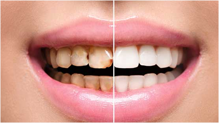 Full Mouth Rehabilitation: How to Rebuild a Smile from Scratch